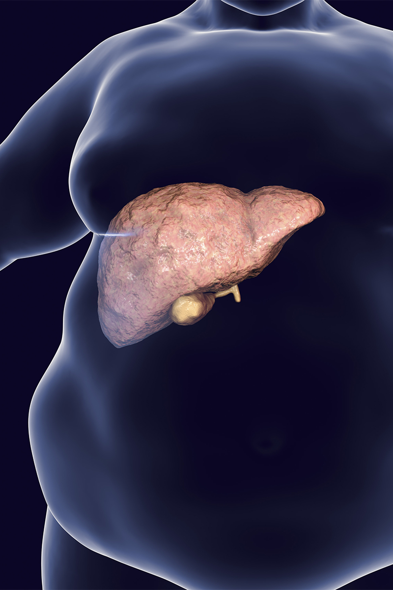 Obese man with fatty liver